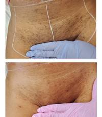 YYC LASER HAIR REMOVAL- Instant, Amazing Results