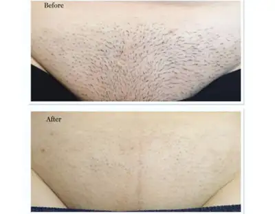 YYC LASER HAIR REMOVAL! Very Affordable Pricing, Instant Results, View more