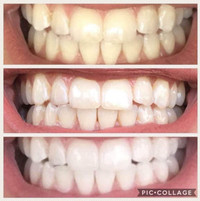 Teeth Whitener at HALF the cost of strips by Kandi Kissed NuSkin