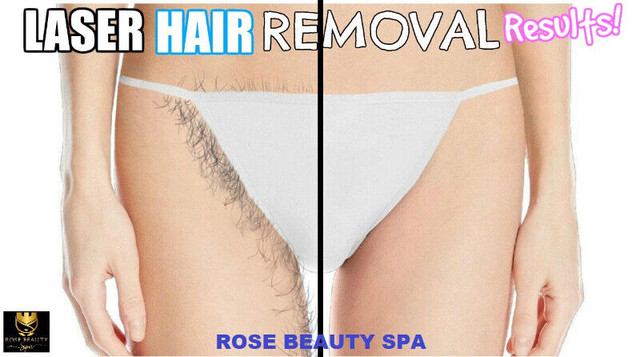 CSA APPROVED - Laser Hair Removal - Painless - Guarantee Results | Health &  Special Needs | Mississauga / Peel Region | Kijiji