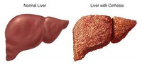 Cirrhosis of the Liver Program North York