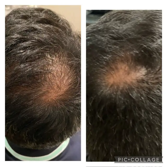 Microneedling with Exosomes & PDRN64623143300097122