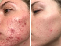 ACNE SOLUTIONS - Plant Based with Zero Side Effects