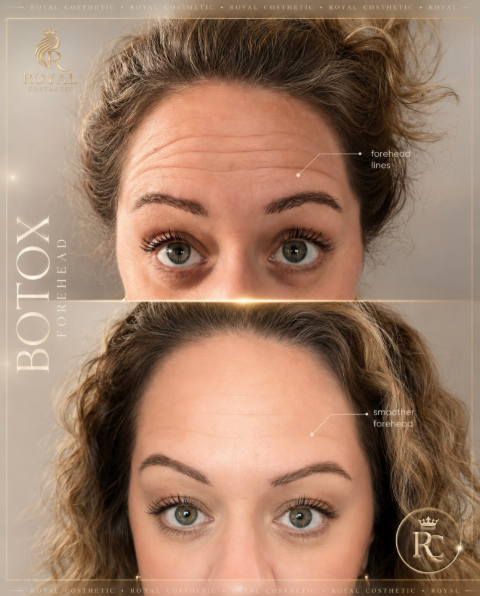 BRAMPTON | BOTOX® | $9 PER UNIT in Health and Beauty Services in Mississauga / Peel Region - Image 3
