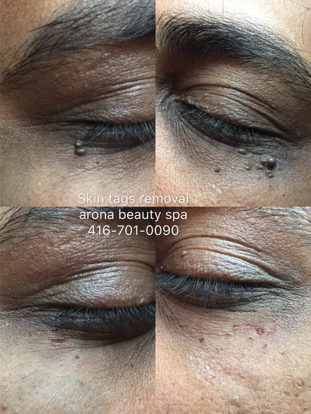 Skin tags removal 50% off in Health and Beauty Services in City of Toronto - Image 3
