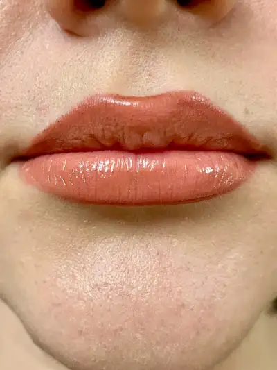 PROMOTION FOR BOTOX $4.5 per unit /FILLER 260$ PER Syr, View more