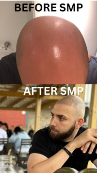 SMP Treatment - GET YOUR CONFIDENCE BACK!