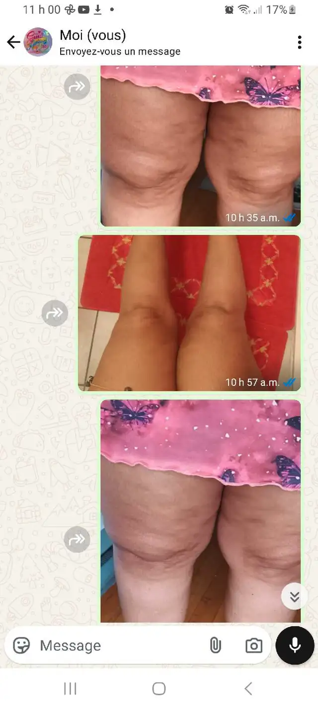 MASSAGE AND CELLULITE632406752149791225