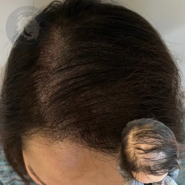 Scalp Micropigmentation | SMP | Hair & Scalp Tattoo | Hairline62863238047234122