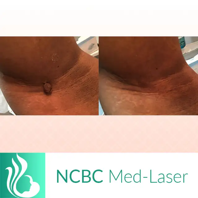 Mole/Skin tag / Scar/ Birthmark  removal -50% off in Massage Services in City of Toronto - Image 2