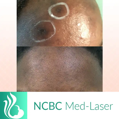 Mole/Skin tag / Scar/ Birthmark  removal -50% off, View more