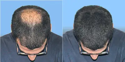 Instantly Conceal Thinning Hair – No Surgery, No Medication, View more