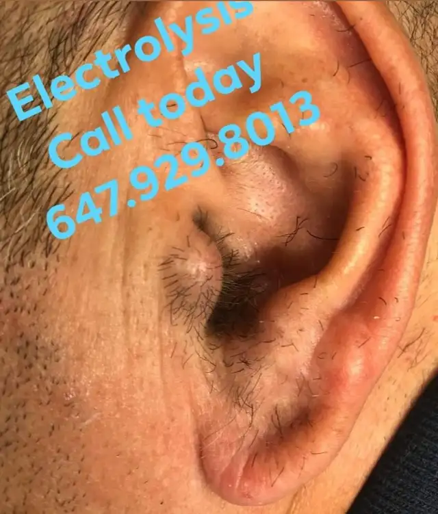 Permanent Hair Removal Calgary – Electrolysis Specialist - 4 All630056652161291212