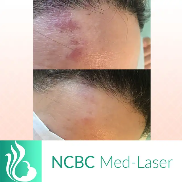 Mole/Skin tag / Scar/ Birthmark  removal -50% off in Massage Services in City of Toronto - Image 5