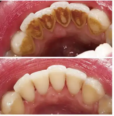 Hi everyone! I'm a foreign trained dentist and currently enrolled in the Dental Hygiene program at O...