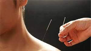 Best Deep Tissue Massage (RMT)and Acupuncture and Cupping in Cleaners & Cleaning in Oakville / Halton Region - Image 3