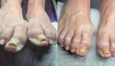Foot care nurse at home, View more