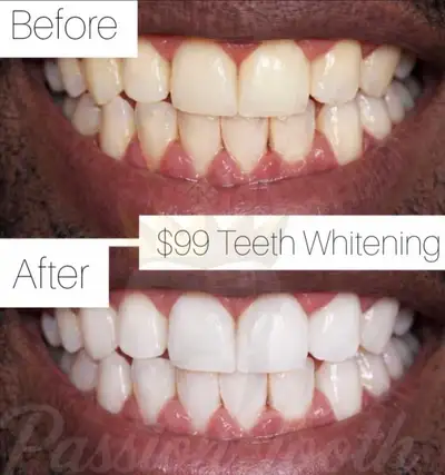 Wedding/Event/Party/Photoshoot? $99 Dental Whitening , View more