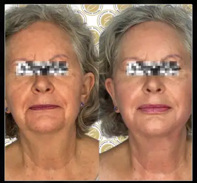  medical training, $6 dollars a unit Botox price, View more