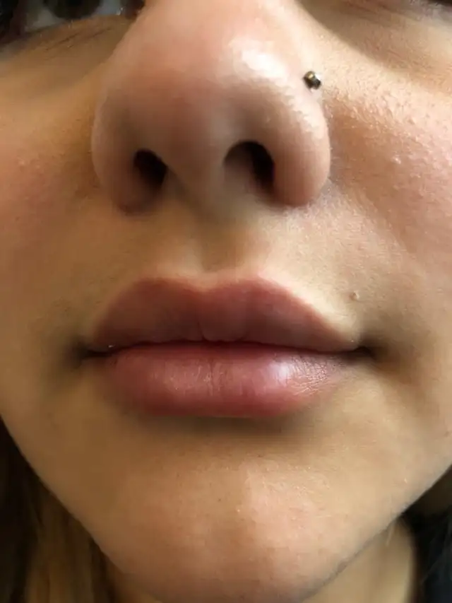 PROMOTIONS BOTOX 4.5$ per unit FILLER 270$  MOBILE SERVICES GTA in Health and Beauty Services in City of Toronto - Image 3