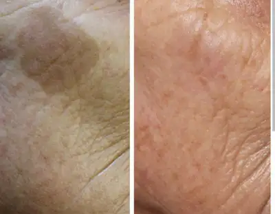 FLORADALE AESTHETICS OFFERS FULL BODY LAEER HAIR REMOVAL $140 INCLUDING EVERYTHING . DIOLAZE TIATATI...