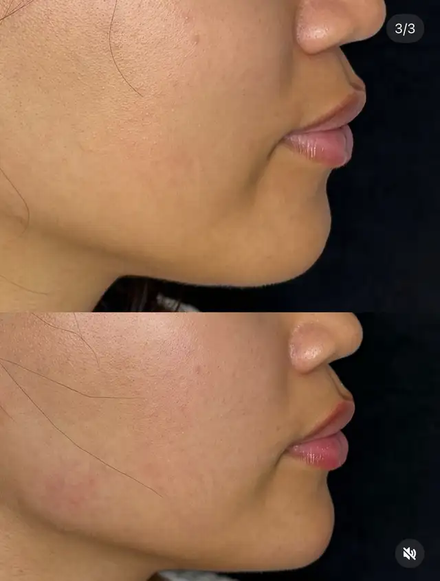 Botox- filler 64519987427713122