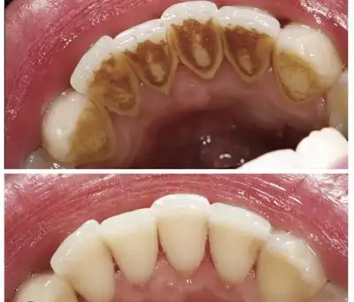 FREE DENTAL CLEANING FROM DENTAL HYGIENE STUDENT, View more