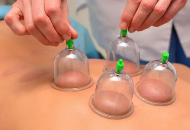 Hijama in Markham536176024324689926