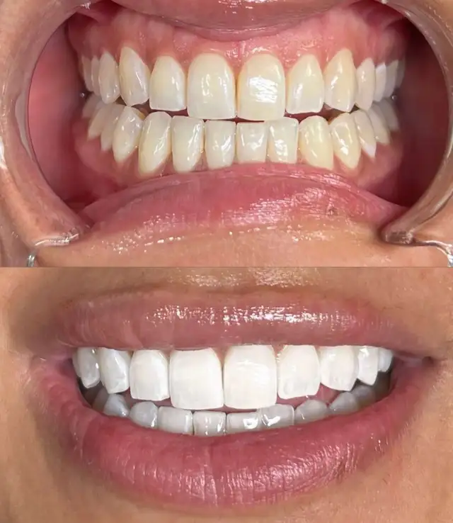 TEETH WHITENING $75 Certified Dental Assistant63006658908033122