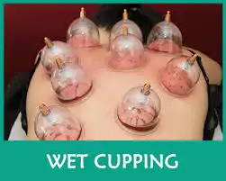 Hijama in Markham