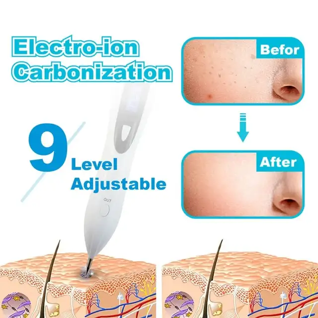 Electronic Skin Tag Remover, Skin Tags Removal Pen in Other in City of Montréal - Image 3