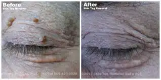 *--Skin -Tag removal, Milia, Cherry angioma, Red spots, Dark spots (DPN), Sebaceous Hyperplasia, Fib...