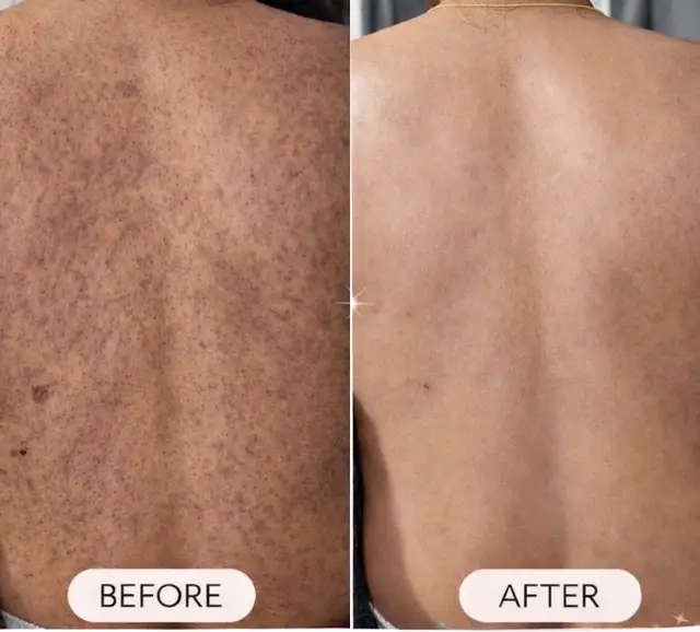 back acne  peel treatments 
