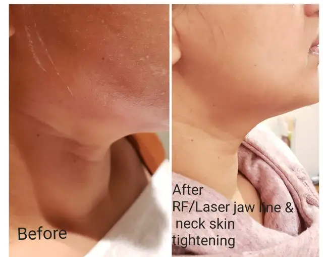 Microneedling with Exosomes & PDRN64623143300097124