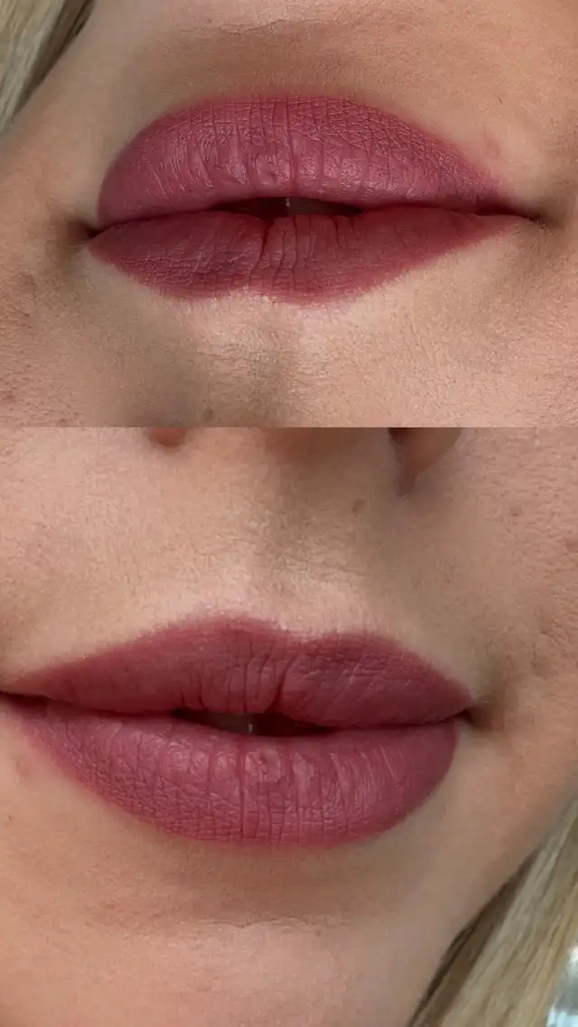 Botox filler - PRP - fat dissolving - skin booster63234910750977124