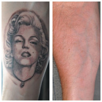 TATTOO REMOVAL - 4 TIMES FASTER