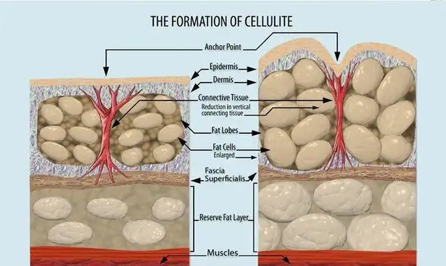 Massage professionnel thérapeutique et anti-cellulite. in Massage Services in City of Montréal - Image 5