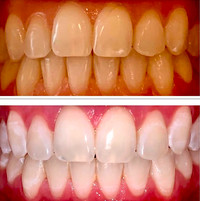 Teeth Whitening Certification