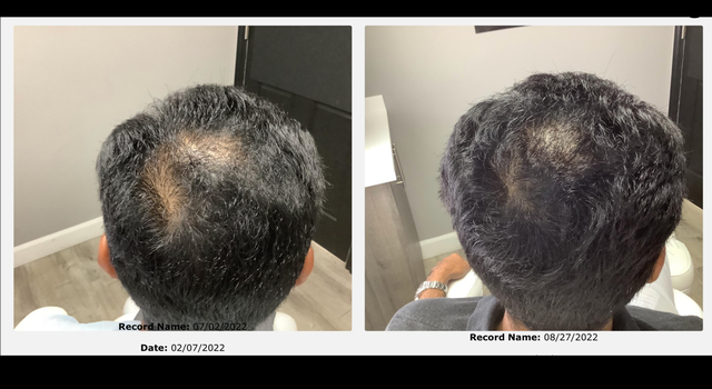 Microneedling with Exosomes & PDRN64623143300097121