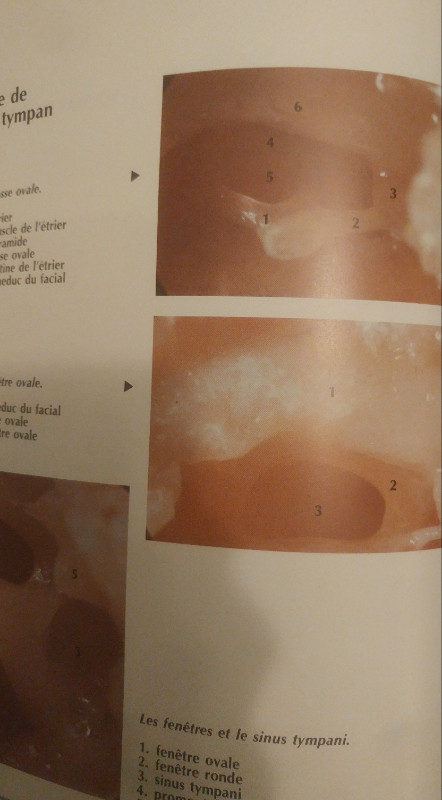 Atlas commenté d'otoscopie. Pathologie du conduit auditif ext... dans Manuels  à Longueuil/Rive Sud - Image 4