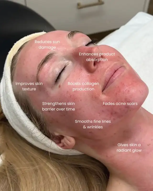 ✨ Nurse-Led PRP, Microneedling, IV Drips & Facials – Oshawa ✨633733905409291216