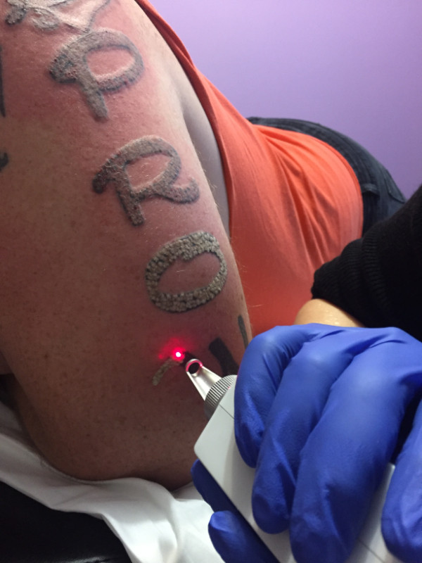 Tattoo Removal Laser - Easy to Operate Equipment in Health & Special Needs in Victoria - Image 3