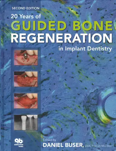 20 Years of Guided Bone Regeneration in Implant Dentistry, View more