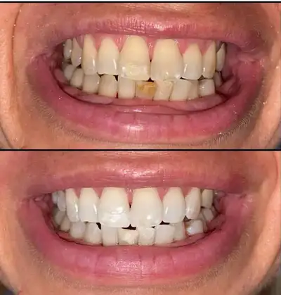blanchiment dentaire/ teeth whitening, View more