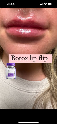 Botox and fillers