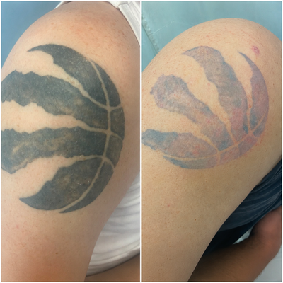 Laser Tattoo Removal – Markham Med Spa, View more