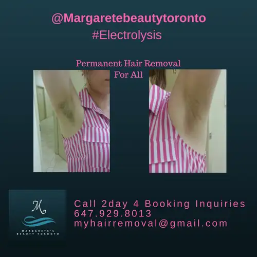 Permanent Hair Removal Calgary – Electrolysis Specialist - 4 All63005665216129122