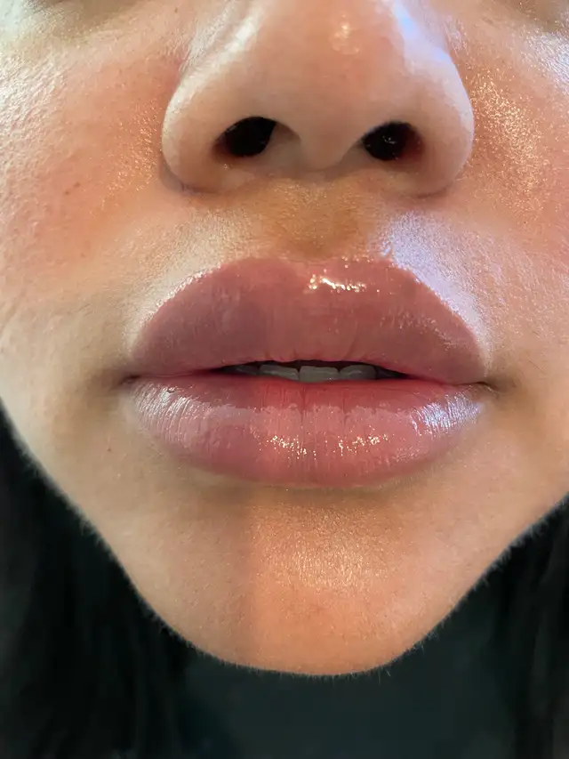 PROMOTIONS BOTOX 4.5$ per unit FILLER 270$  MOBILE SERVICES GTA in Health and Beauty Services in City of Toronto - Image 5