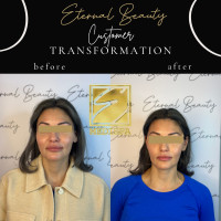 Non-surgical Facelift (look 10 years younger with threadlift)