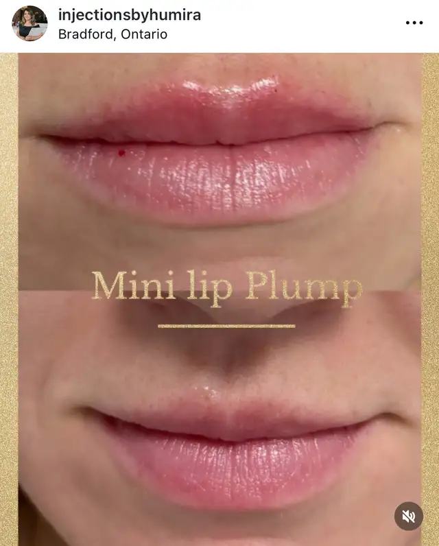 Botox- filler 64519987427713120